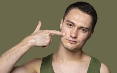 How to Get Rid of Acne Scars Naturally